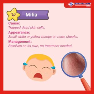 Rash in baby milia