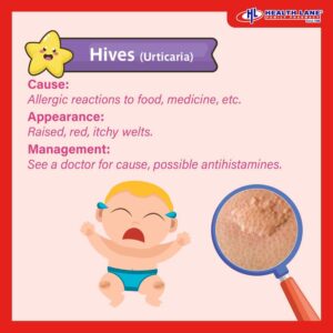 Rash in baby hives