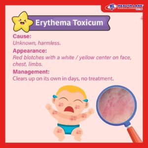 Rash in baby erythema toxicum